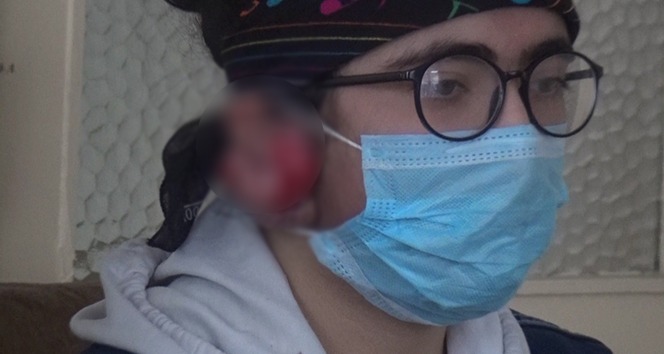 7 yaşında taktığı küpenin alerji yapması hayatının felaketi oldu